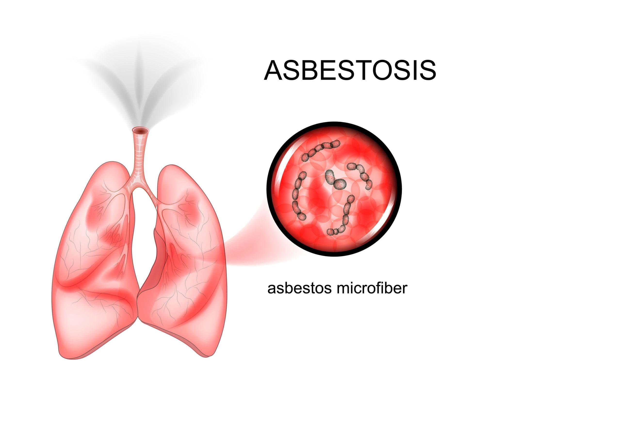 Asbestos Lung Cancer